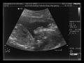 16-02-06 20 weken echo scan 1